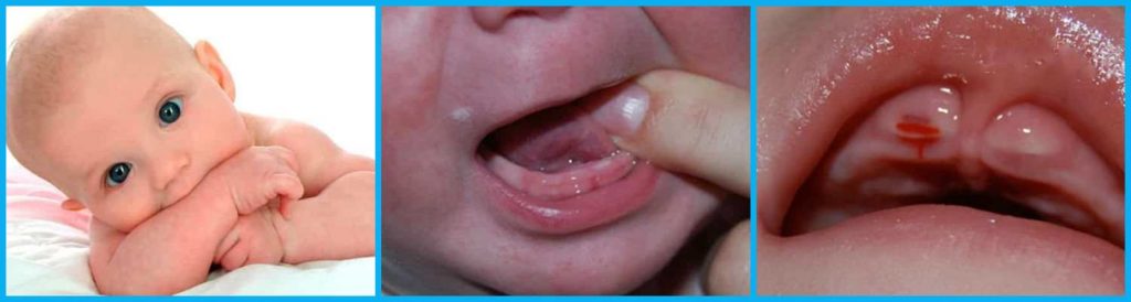 Этапы прорезывания зубов у новорожденных детей | BabyDent