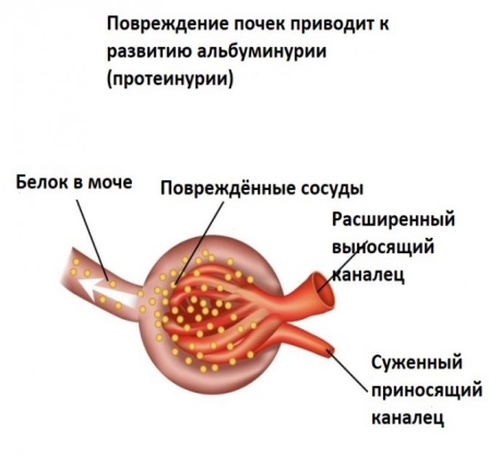 белок в моче при сахарном диабете — 25 рекомендаций на thebestterrier.ru