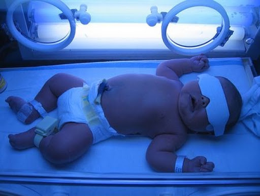 Физиологическая желтуха новорожденных | Неонатальная желтуха