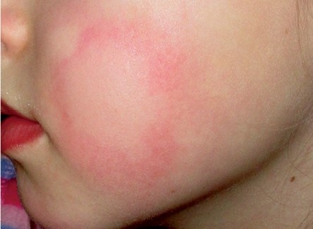 Аллергия на холод - причины, симптомы, признаки, лечение, профилактика холодовой аллергии